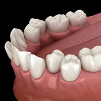 Illustration of crooked teeth