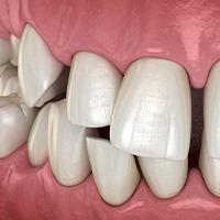 Illustration of gapped teeth