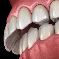 Illustration of an overbite