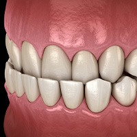 Illustration of an underbite