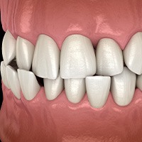 Illustration of a crossbite