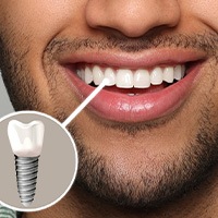 Nose-to-neck view of man smiling with a tooth indicated as an implant