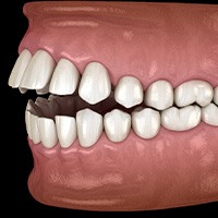Illustration of an open bite