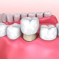 Illustration of a dental crown in Owings Mills attached to tooth