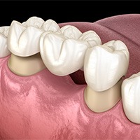 Illustration of dental bridge in Owings Mills being attached to teeth