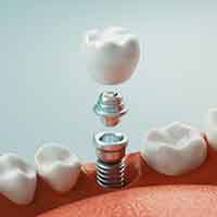 A 3D illustration of a dental implant’s parts